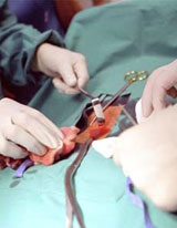 Prostate Cancer Surgery Prostate Cancer Surgery