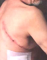 Scarring After Cancer Surgery Scarring After Cancer Surgery