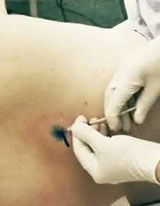 Skin Cancer Surgery Skin Cancer Surgery