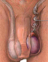 Testicular Cancer Surgery